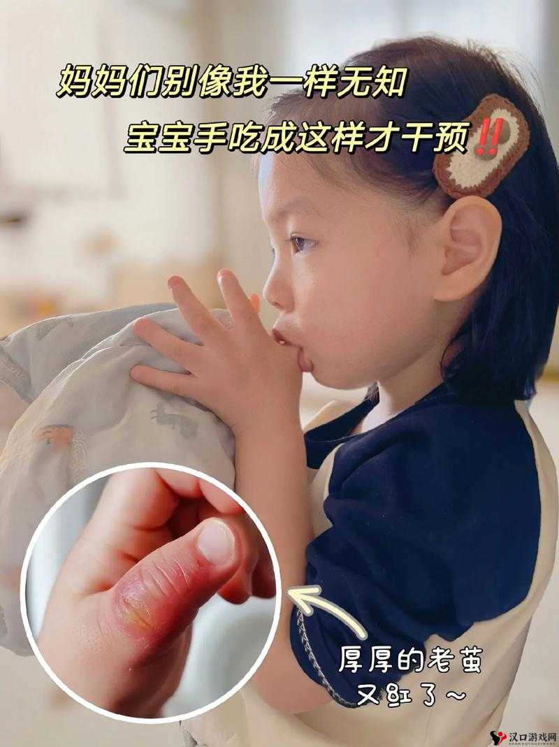 宝宝才三根手指就如此疼令人揪心不已