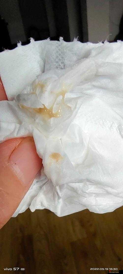 胡桃尿道口流出白色脓状物究竟是什么原因导致