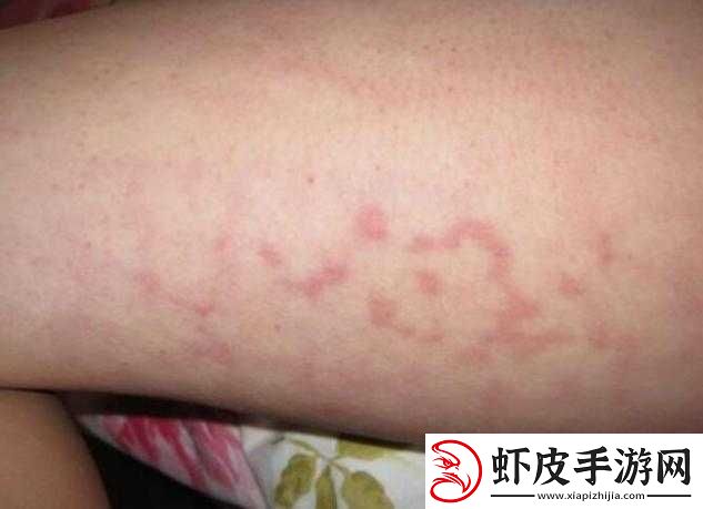 淑芬大腿内瘙痒难耐引发的一系列状况