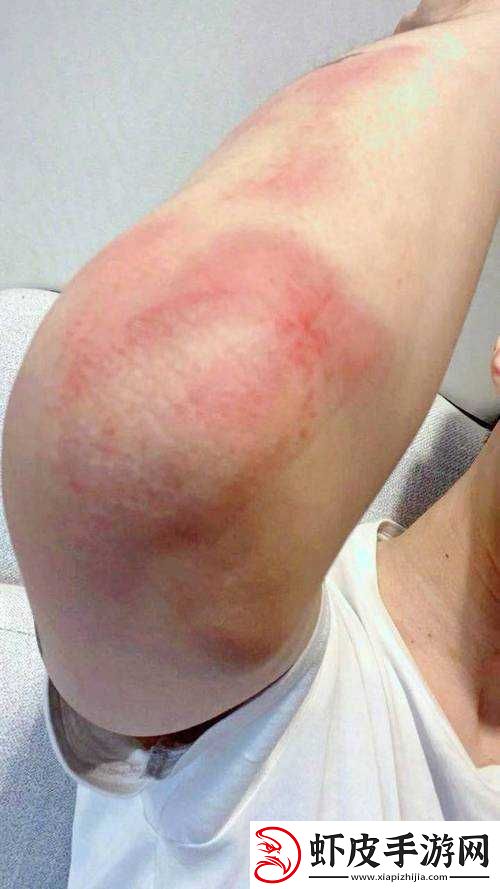 红肿疼痛小缝不能合拢