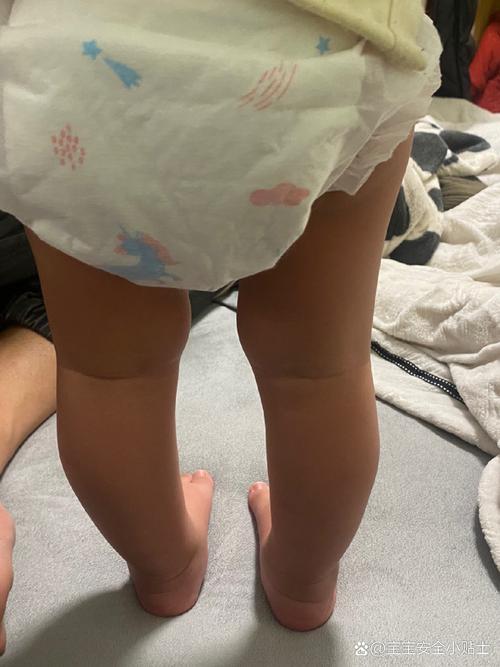 宝贝的腿张大点就不疼了